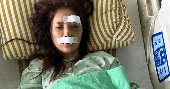 36歲女星騎單車摔傷毀容，歷時7小時手術，術后家人擔心引發癲癇